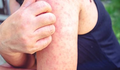 Kızamık belirtileri neler, nasıl geçer?